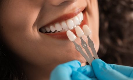 Recovery and Care After Getting Veneers